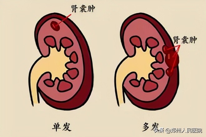 如何预防囊性肿瘤及囊肿,囊肿和肿瘤的判断方法