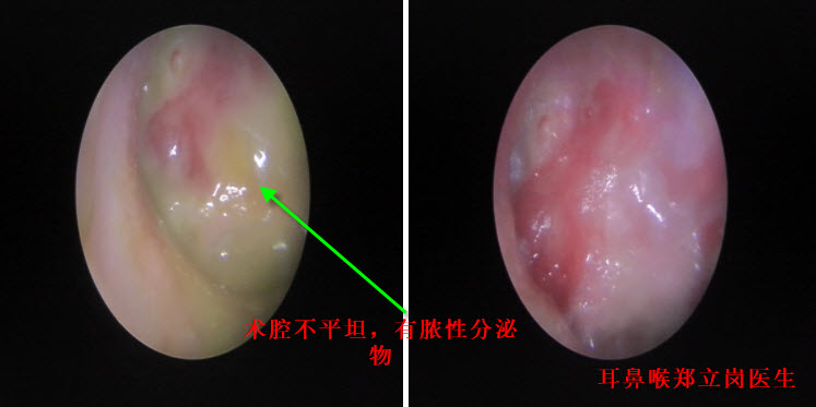 中耳炎手术后一直流脓怎么办,中耳炎术后复发吃什么药