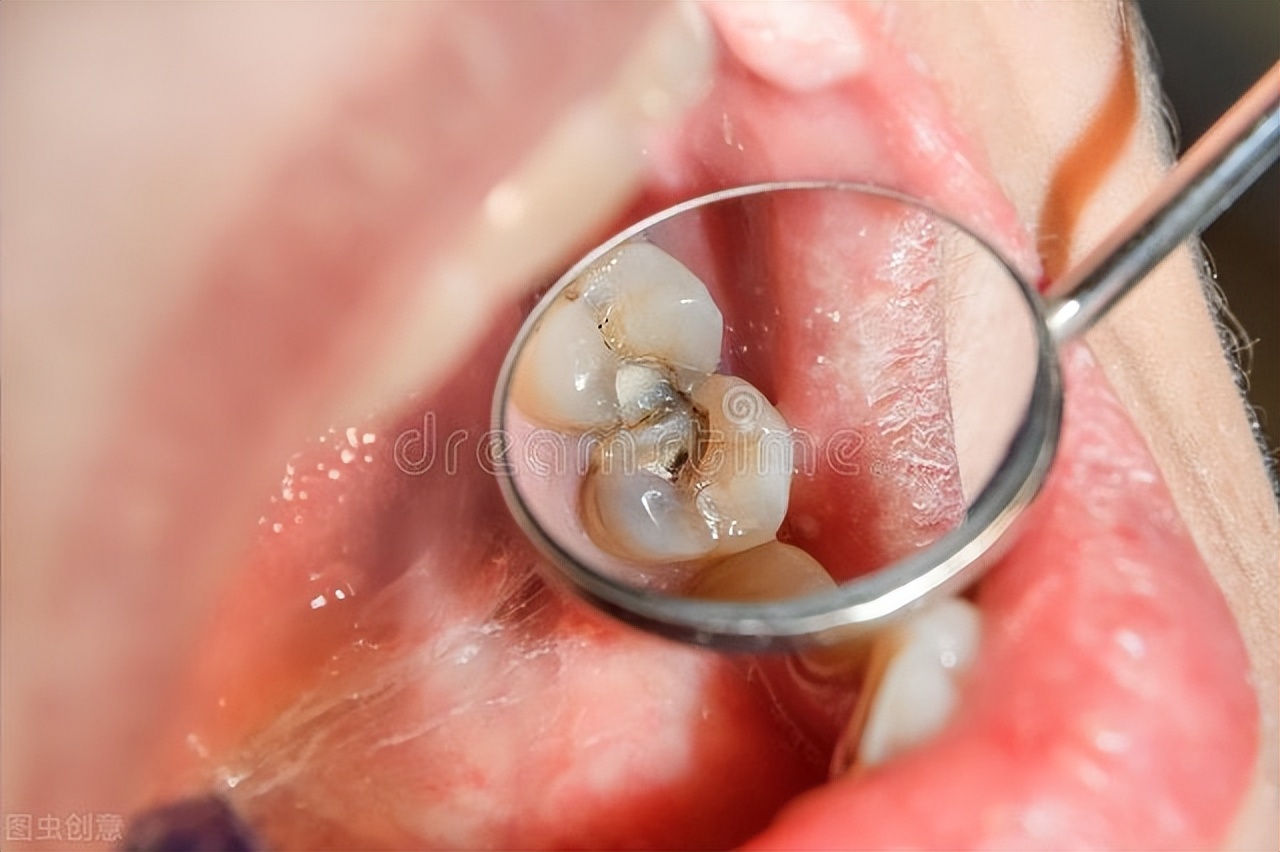 烂牙但是不痛,烂牙不痛也会出血怎么办