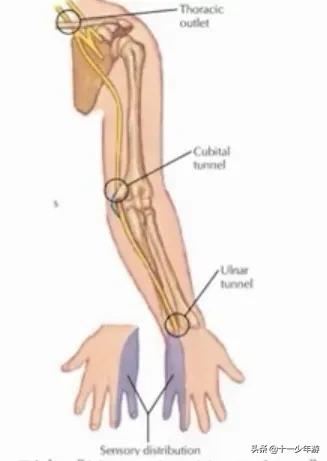 周围神经病和外周神经病,周围神经病