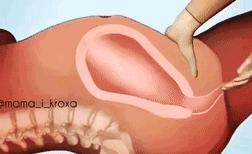 医生把胎盘拿走了,21天胎盘留体内