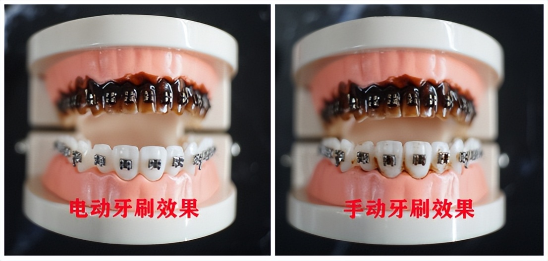 电动牙刷能减少牙龈的伤害吗,电动牙刷对牙龈有什么影响