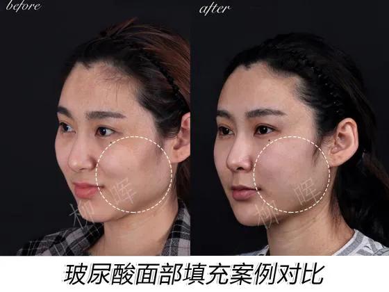 面颊凹陷玻尿酸一般填充多少钱,面颊凹陷玻尿酸好还是脂肪填充好