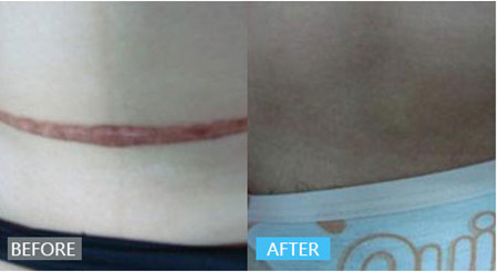 像个“小肉球”似的增生疤痕，是不是无药可救了？医生这样说：