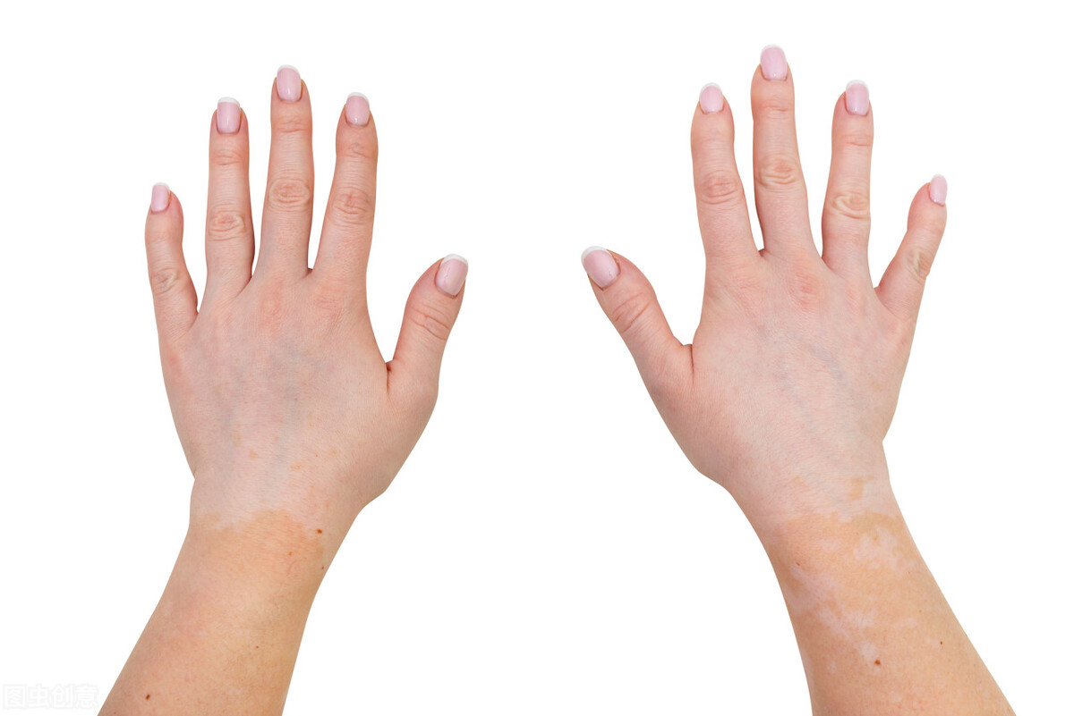 白癜风如何确诊和治疗,白癜风初步诊断方法