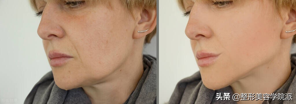 女29岁嘴角法令纹怎么办,脸部下垂法令纹做拉皮