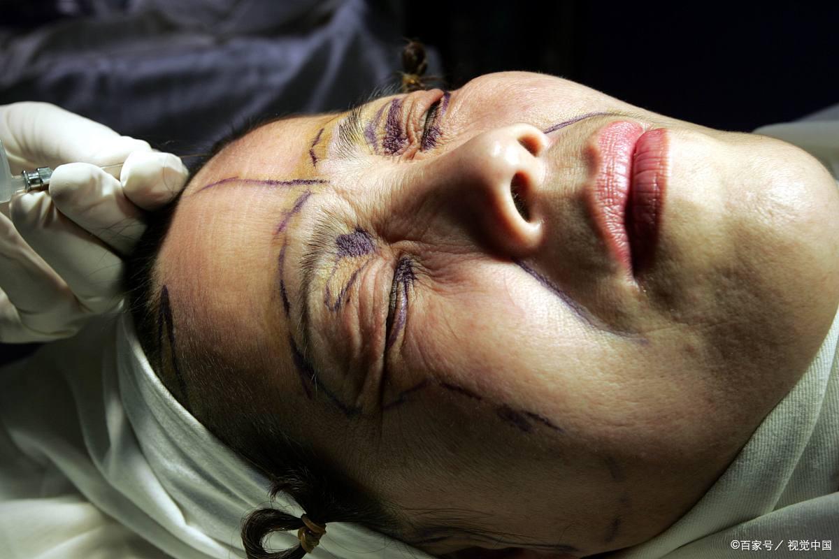 拉皮手术的6个秘密,有做过小拉皮手术的真实案例