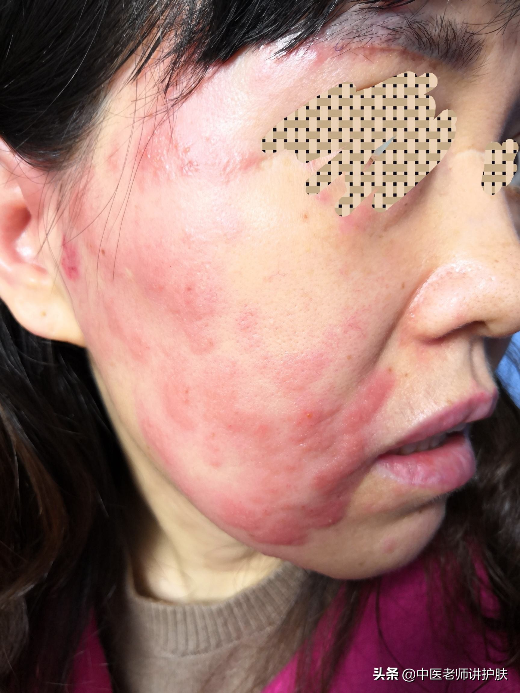 带状疱疹疼痛难忍有什么特殊药物,疼痛带状疱疹