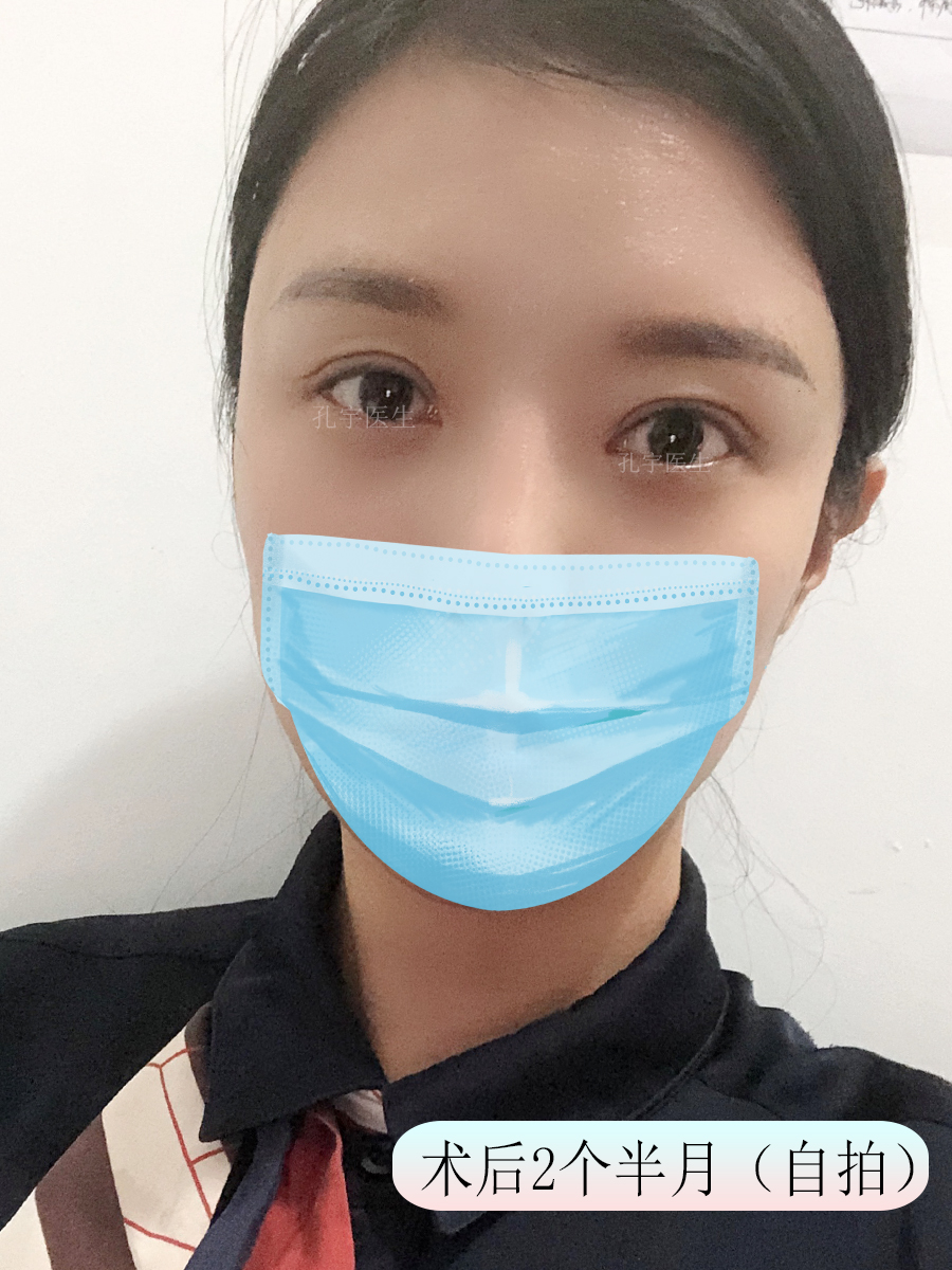 双眼皮修复新乡,姑娘眼部整形后双眼皮变三眼皮