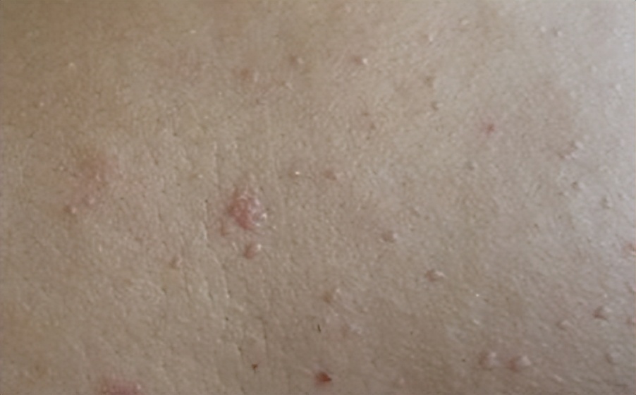 谈谈扁平疣的治疗,关于扁平疣内容