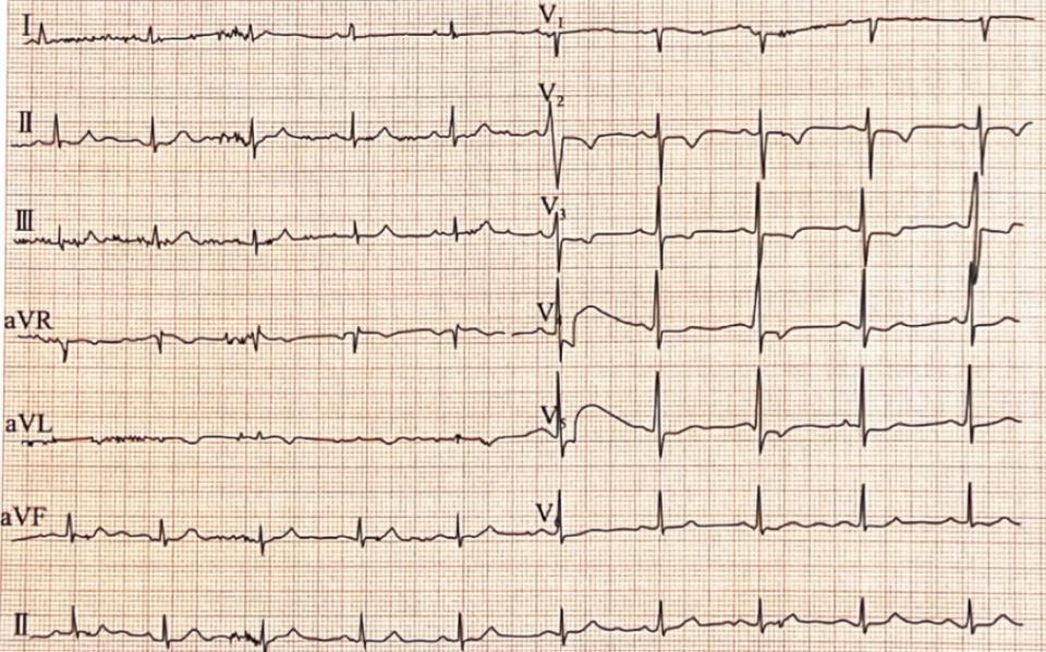 女患者发生扑朔迷离的“心肌梗死”,警惕心碎综合征!