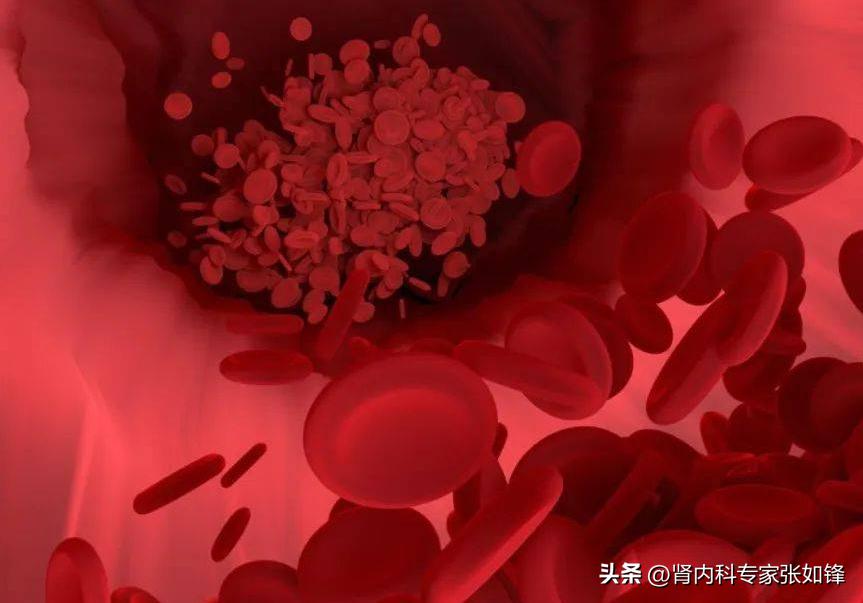 透析患者内瘘堵塞视频,临时管堵塞内瘘又没成熟怎么透析