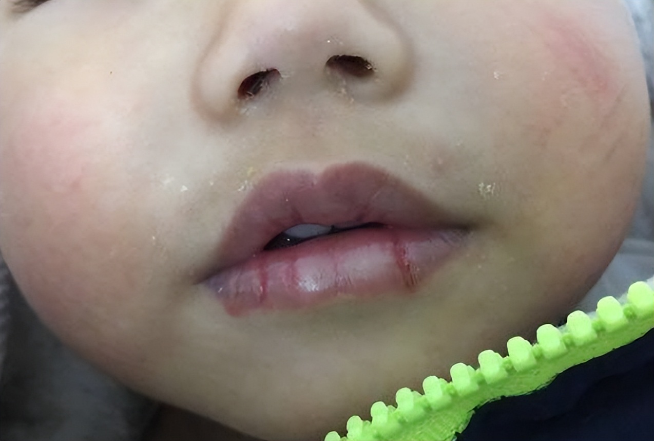 宝宝嘴裂了抹点什么,宝宝嘴巴裂了