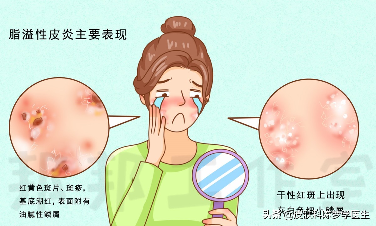 脸上出红斑一定是红斑狼疮吗,脸上长鳞屑红斑性皮疹