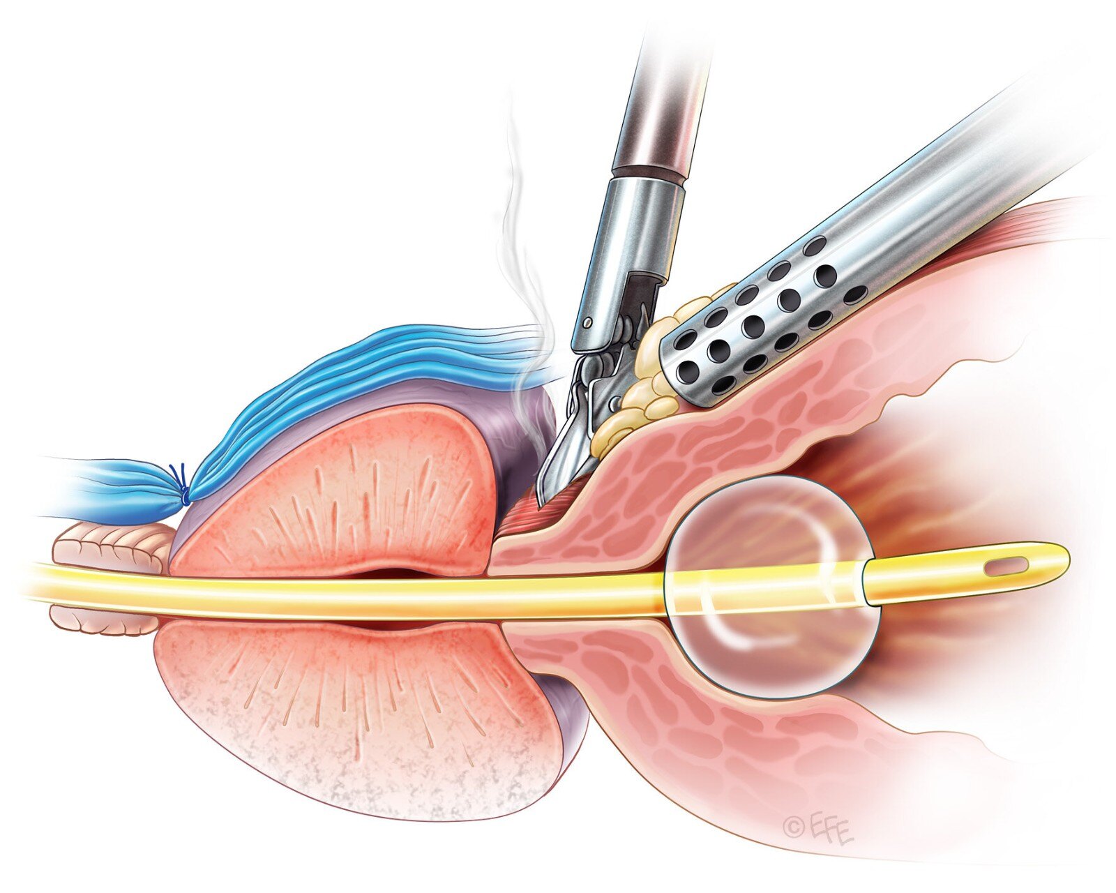 腹腔镜肾切除示意图,腹腔镜肾脏部分切除术