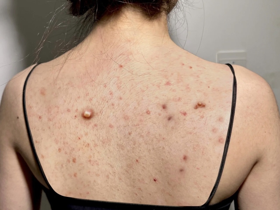 螨虫祛痘最快最有效的方法,沐浴露去螨虫痘痘祛痘印