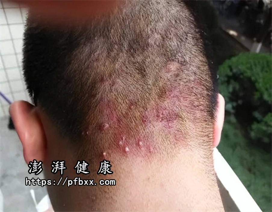 脖子上长痘痘很痒挤了变成硬疙瘩很疼怎么办