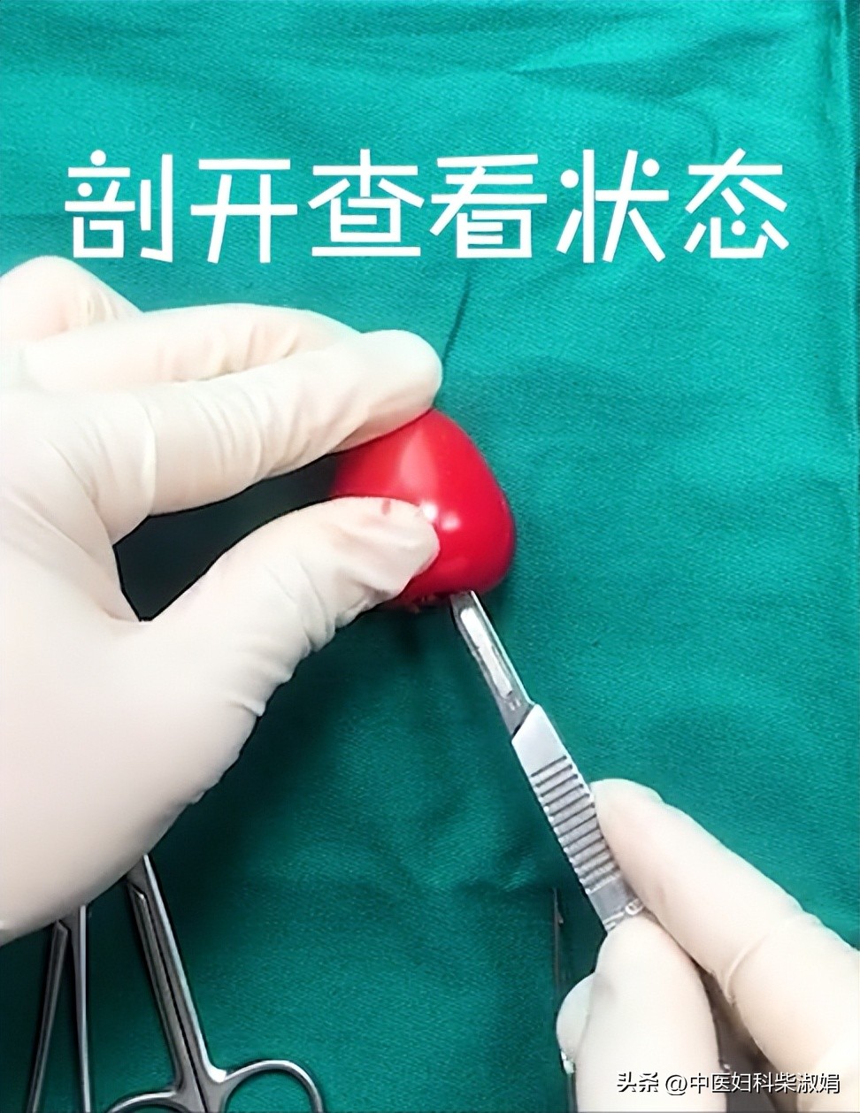 一组图，揭秘人流后的子宫状态，结果太直观了