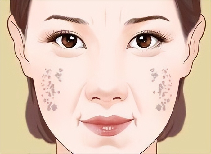 红霉素软膏祛老年斑小妙招,红霉素软膏原来是老年斑克星