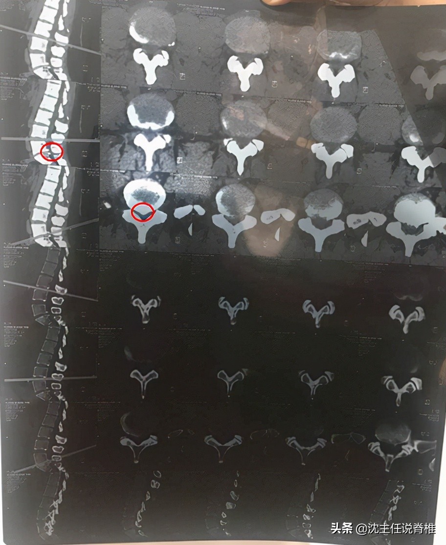 腰椎间盘突出压迫坐骨神经痛腿麻,腰椎间盘突出压迫神经腿麻腿痛