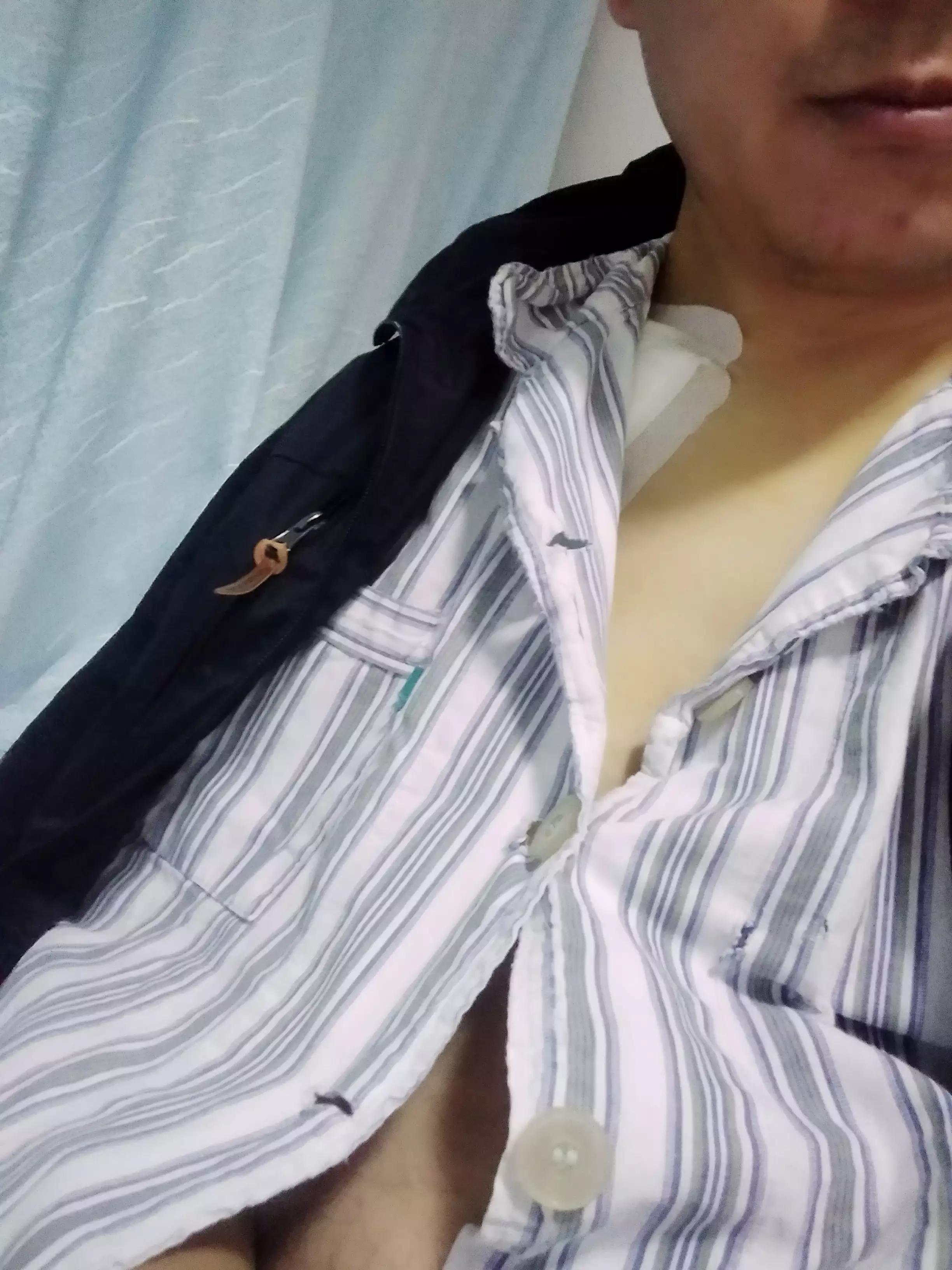 骑车摔倒肋骨骨折怎么办,骑车被摔成粉碎性骨折能痊愈吗