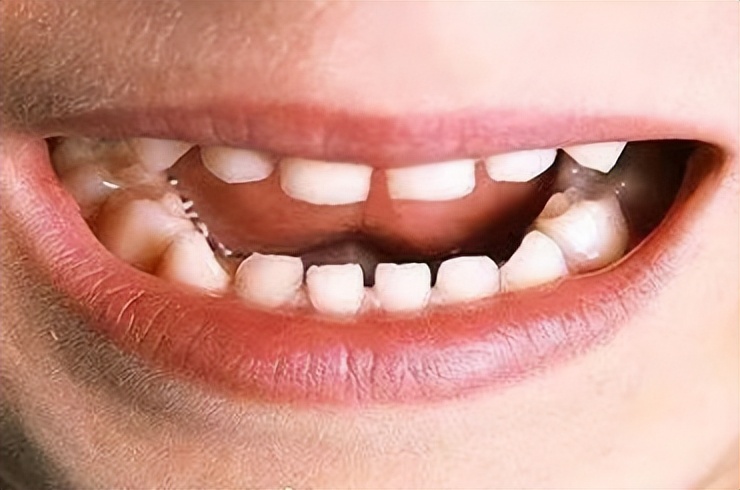 宝宝牙缝有点大这是好还是坏呢,为什么宝宝的牙缝很大