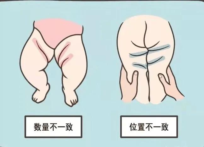 婴儿体检腿不对称怎么回事,医生说孩子两腿发育不对称