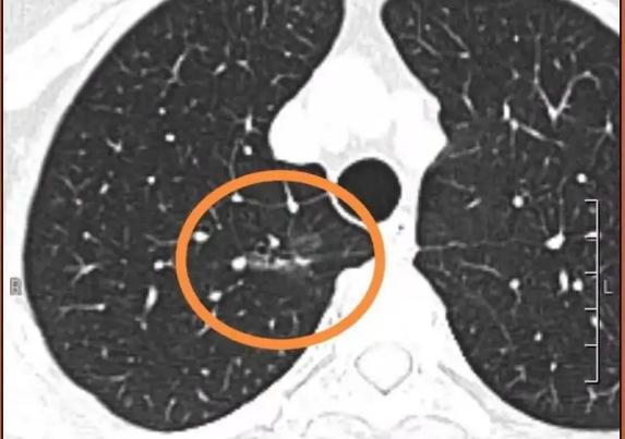 磨玻璃结节7mm癌变的可能性有多大,磨玻璃结节癌变几率有多少