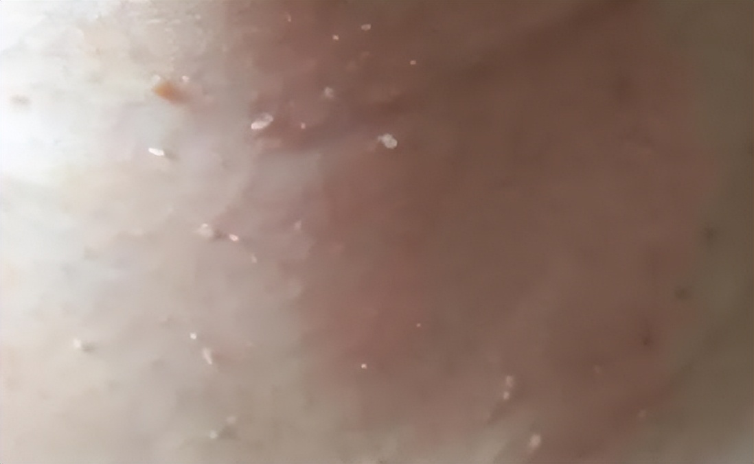 脖子腋下长小肉粒什么原因引起的,脖子上和腋下长小肉粒是什么原因