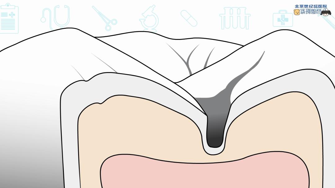 健康科普龋齿窝沟封闭,预防蛀牙科普视频