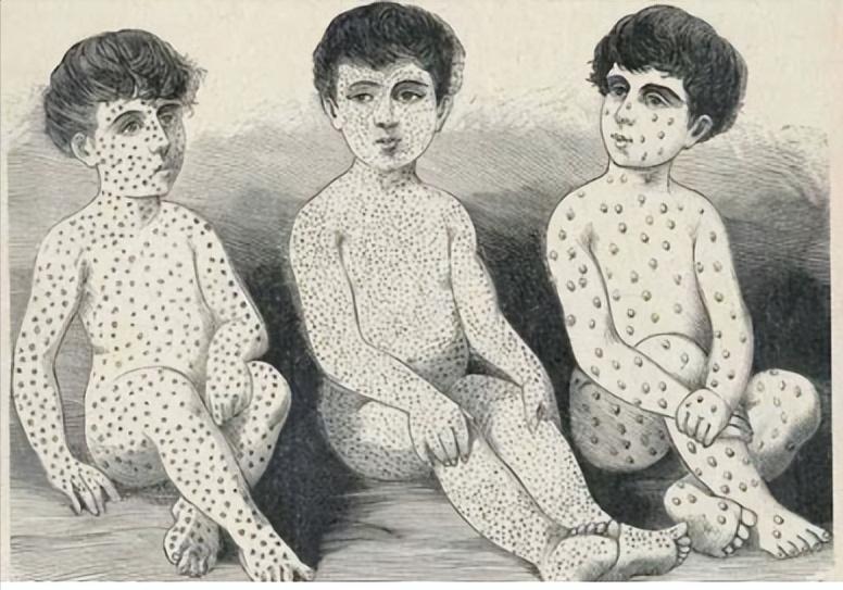 康熙研制了治天花方法吗,康熙的天花被谁治好