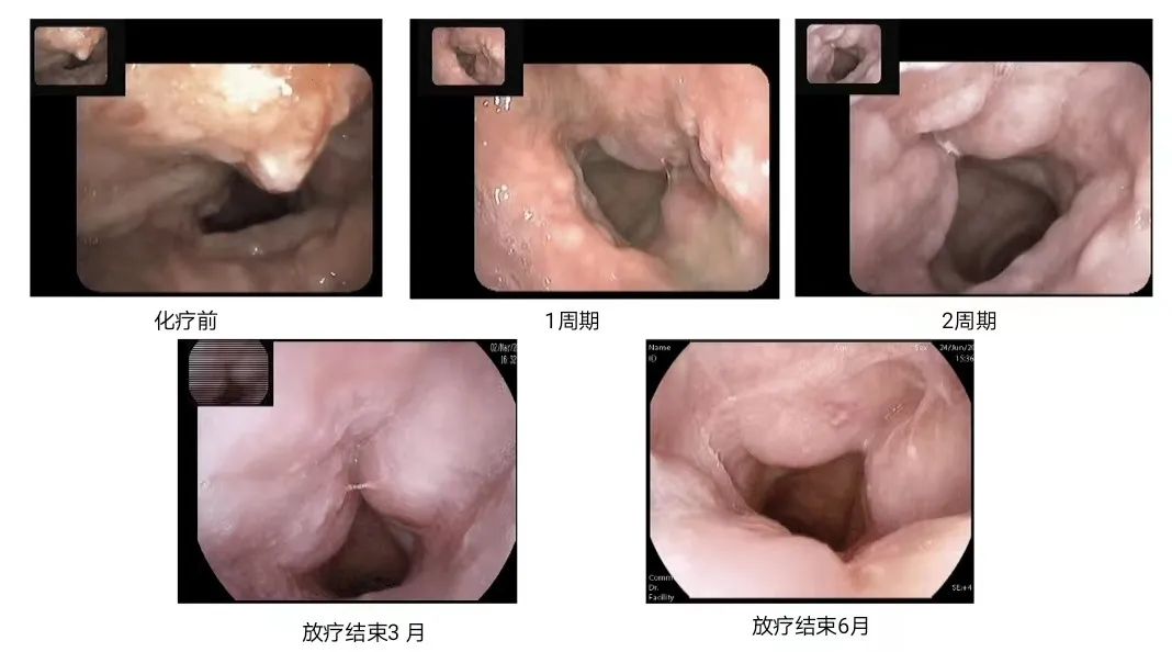 一觉醒来发现嗓子哑了,一觉醒来喉咙都变哑了一直不见好