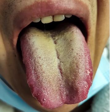 湿热难以清除4个中成药清湿热,十大祛湿热的中成药