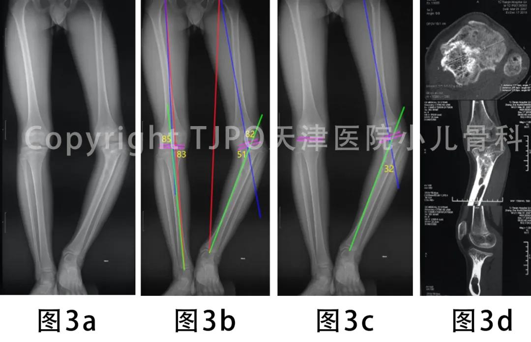 病例分享｜泰勒外固定支架逐渐矫正胫骨近端内翻伴短缩畸形