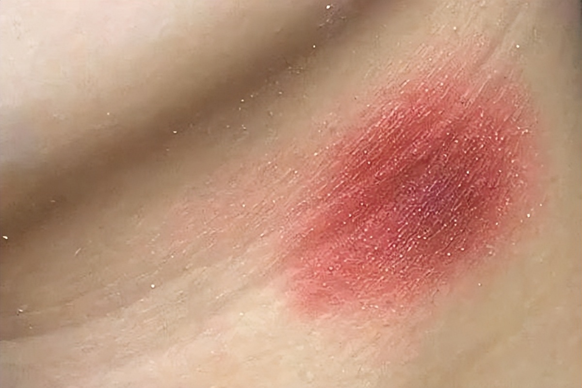 妻子和丈夫同房，被丈夫“种草莓”，第二天匆匆赶到医院，为何？