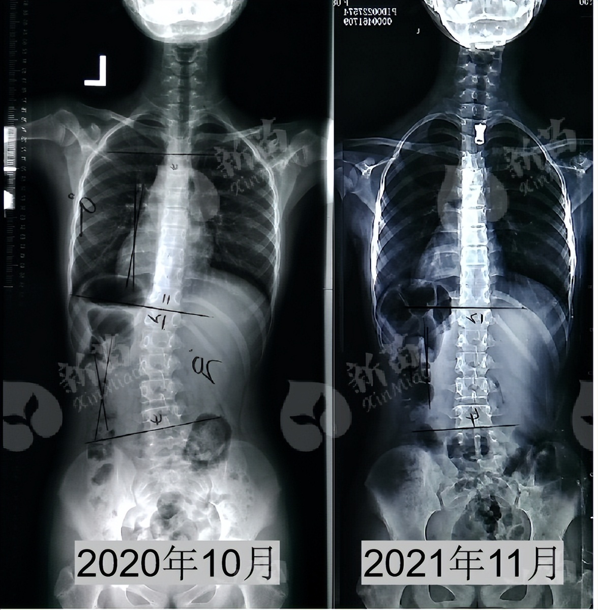 12岁女孩矫正脊柱侧弯,女孩侧弯矫正锻炼