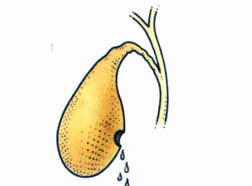 发现肝内胆管结石不治疗会怎样,胆管结石复发率是多少