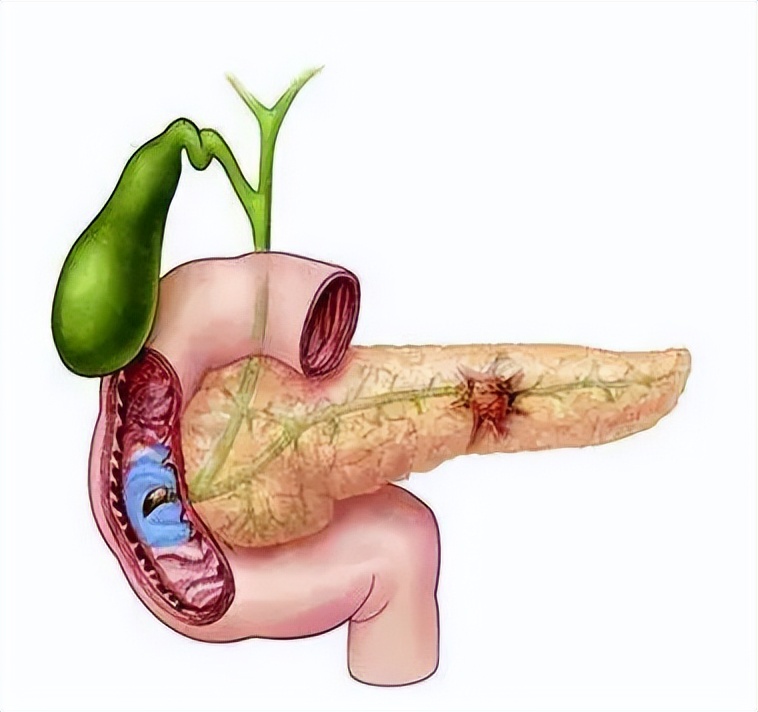 中医治疗胰腺癌的最新疗法,胰腺癌保守治疗方法是什么