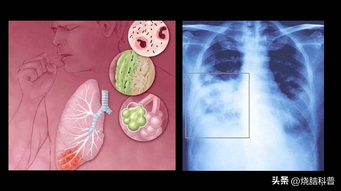 小儿非典型肺炎主要致病菌,细菌性肺炎一般多久才会恢复