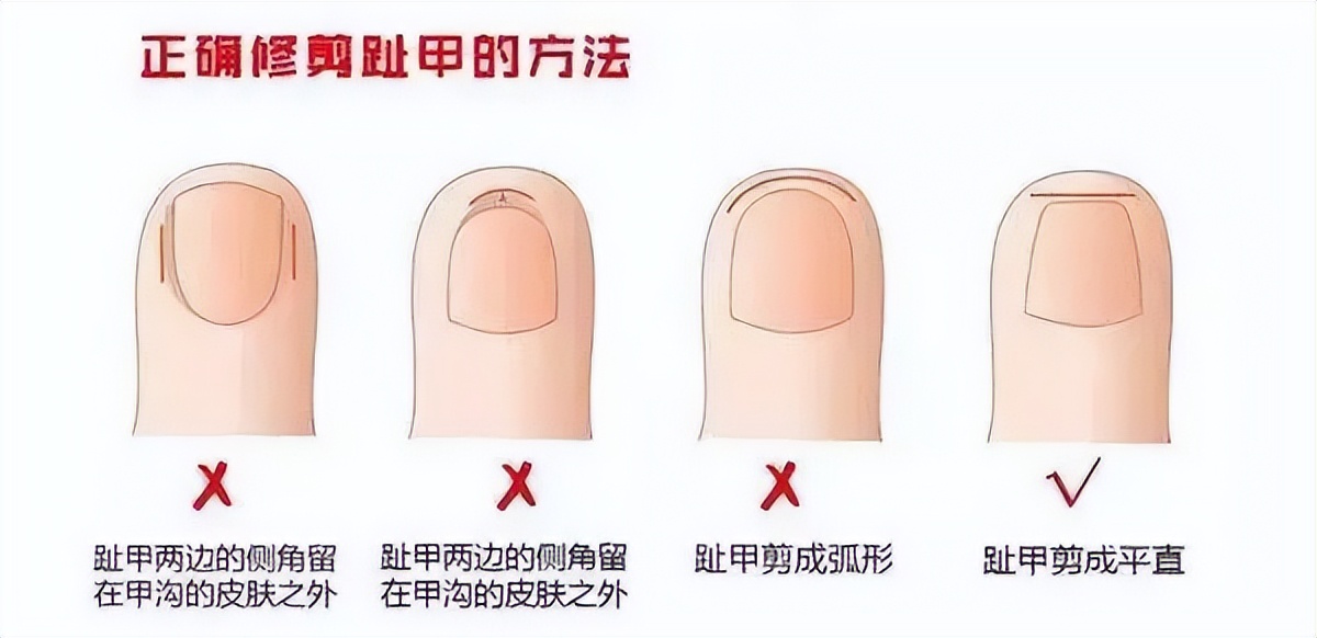 得了甲沟炎之后自己如何处理,得了甲沟炎怎么正确处理