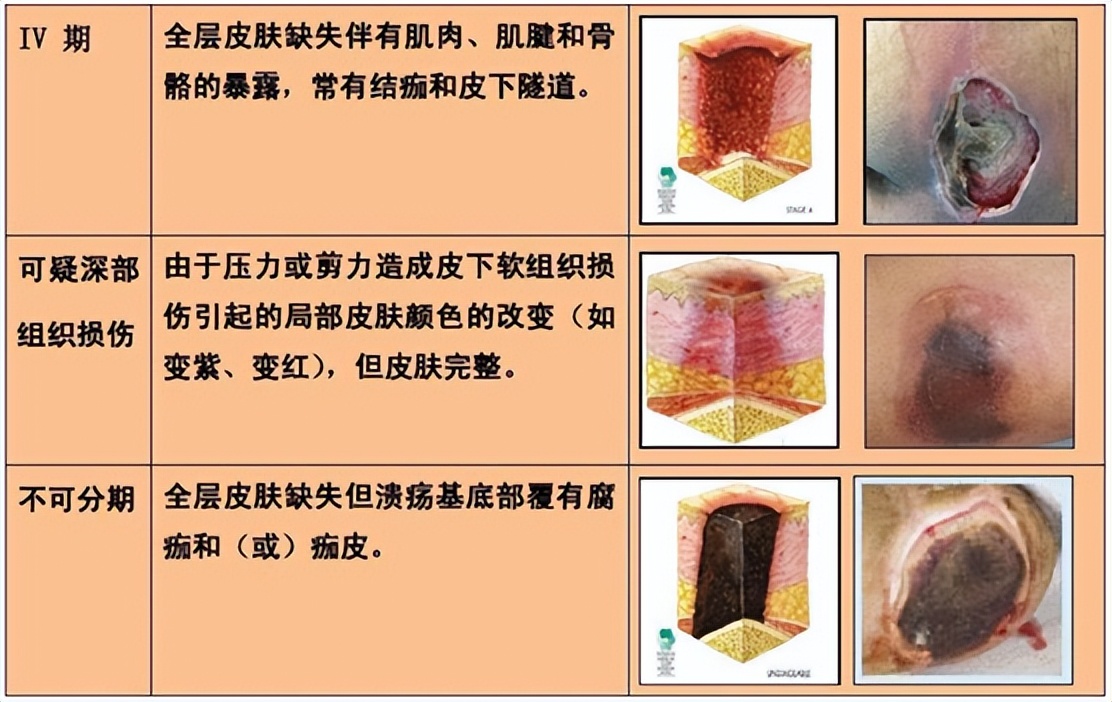 长期卧床压疮如何护理,长期卧床患者压疮的防治方法