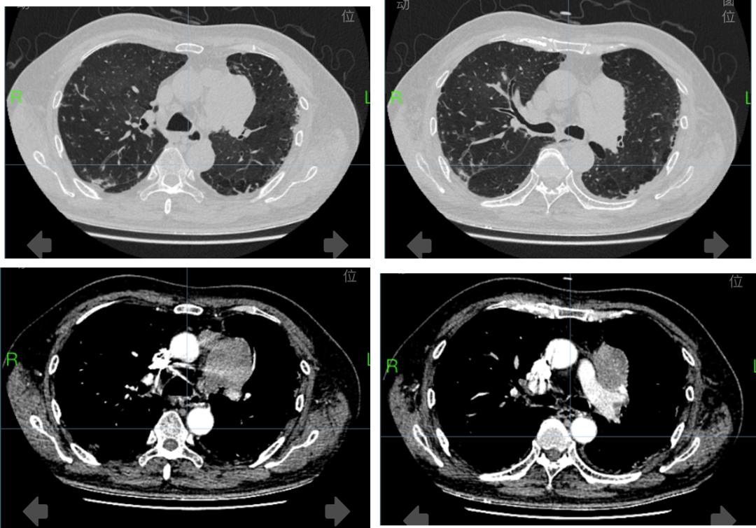 全身肌肉酸痛无力发软是甲流吗,前上纵隔见团块状软组织密度影