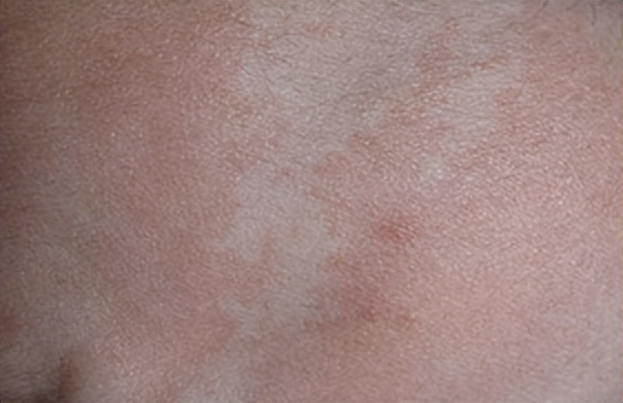 白斑是白癜风还是糠疹如何鉴别呢,白斑处毛发变白就一定是白癜风吗