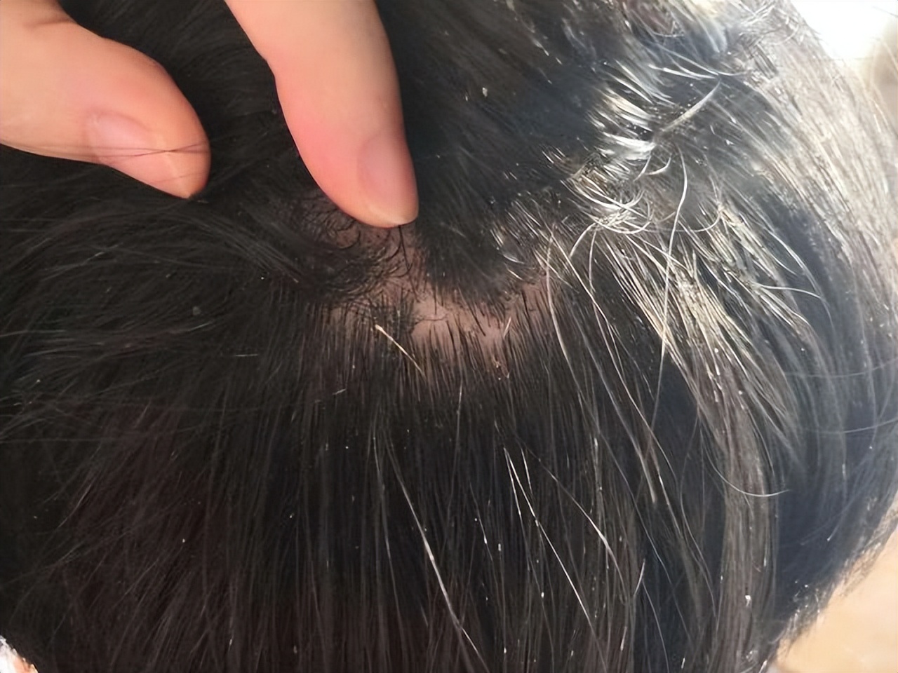 头皮长疙瘩和脓包是什么原因,为什么头皮上经常长脓包和疙瘩