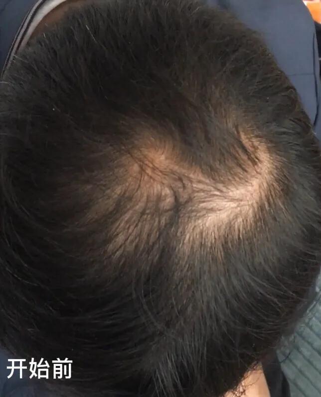 脱发的人日常注意4点,脱发的今日心得100字