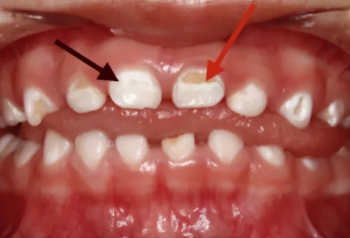 10岁孩子牙齿上有白色斑点,宝宝牙齿上有白色斑点