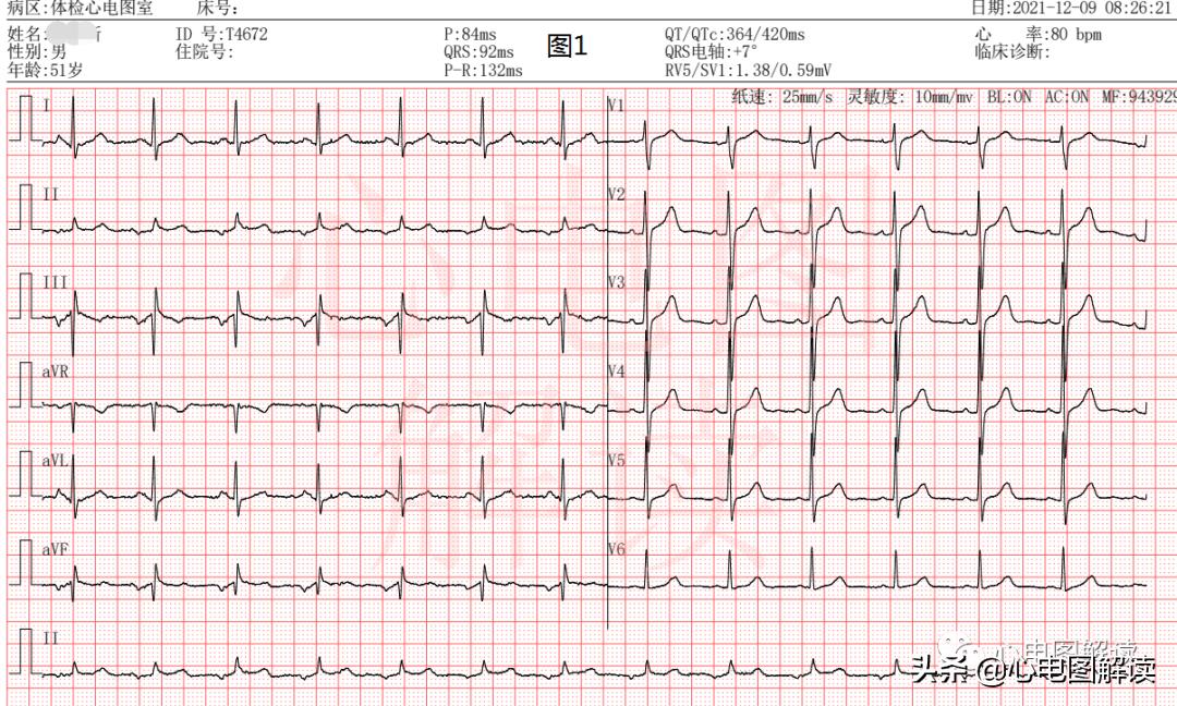 心电图房性心律窦性心律,房性心律与房性自主心律分类