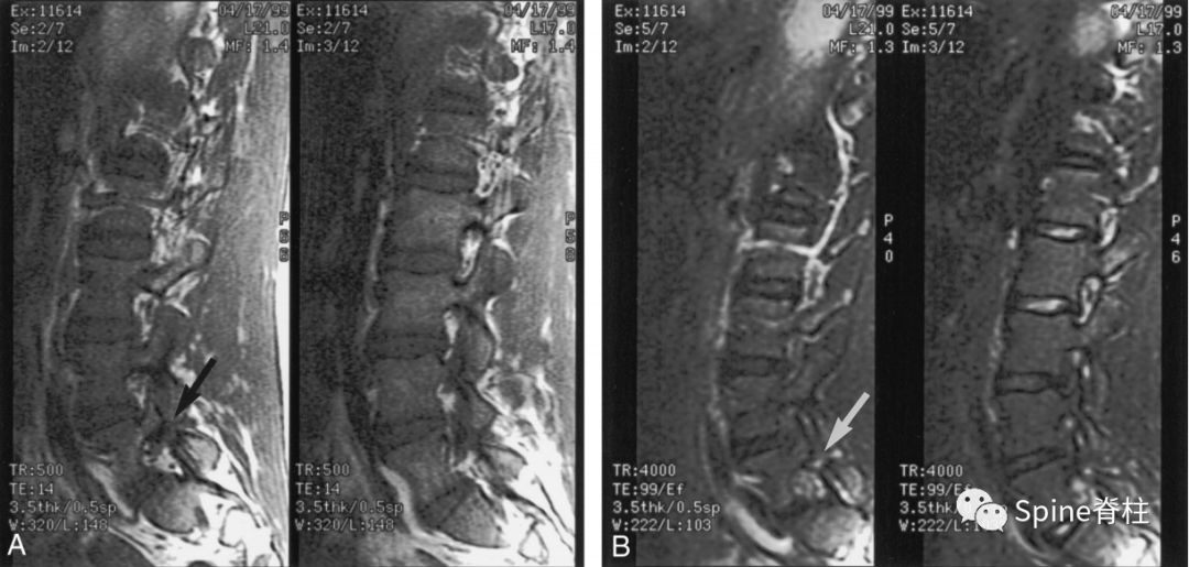 轻度峡部裂和重度峡部裂的区别,真性峡部裂和假性峡部裂