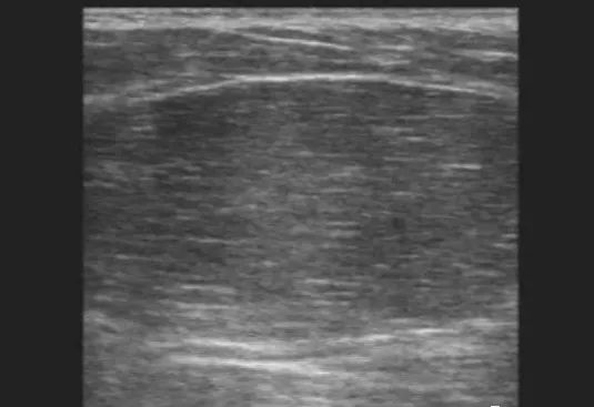 腋窝包块超声鉴别诊断,腋窝淋巴结检查法