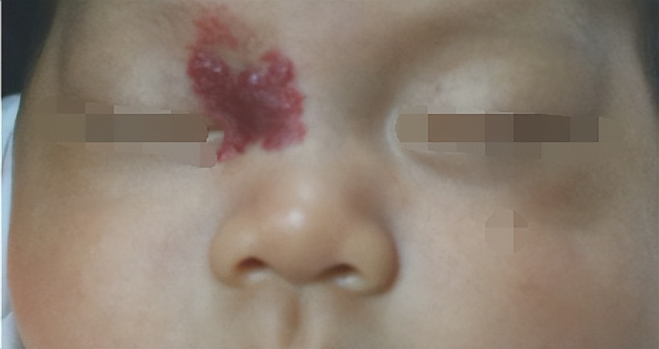 二个月婴儿脸上血管瘤一定会长大,血管瘤能不能等宝宝长大治疗